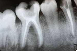 Root Canal